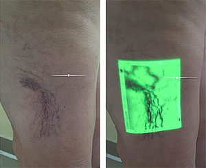 Varizes e varicoses: VEINVIEWER – A imagem vascular projetada para aumentar as taxas de sucesso em procedimentos estéticos de varizes